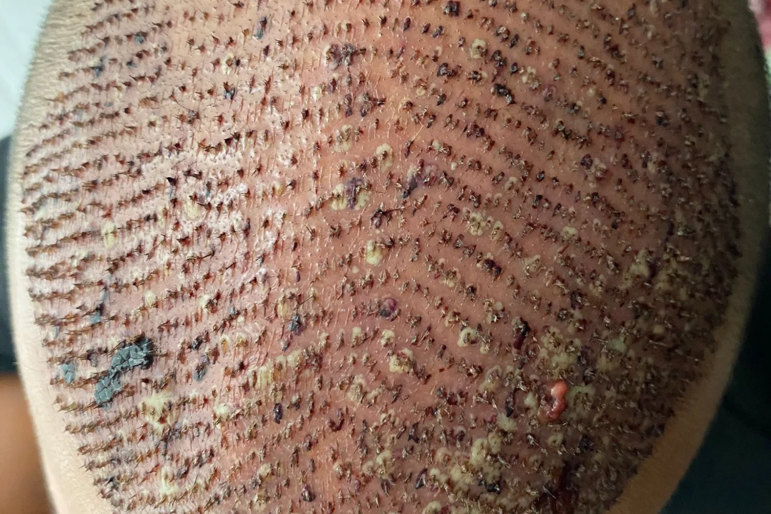FUE oder DHI Haartransplantation: Welche Methode passt zu mir?
