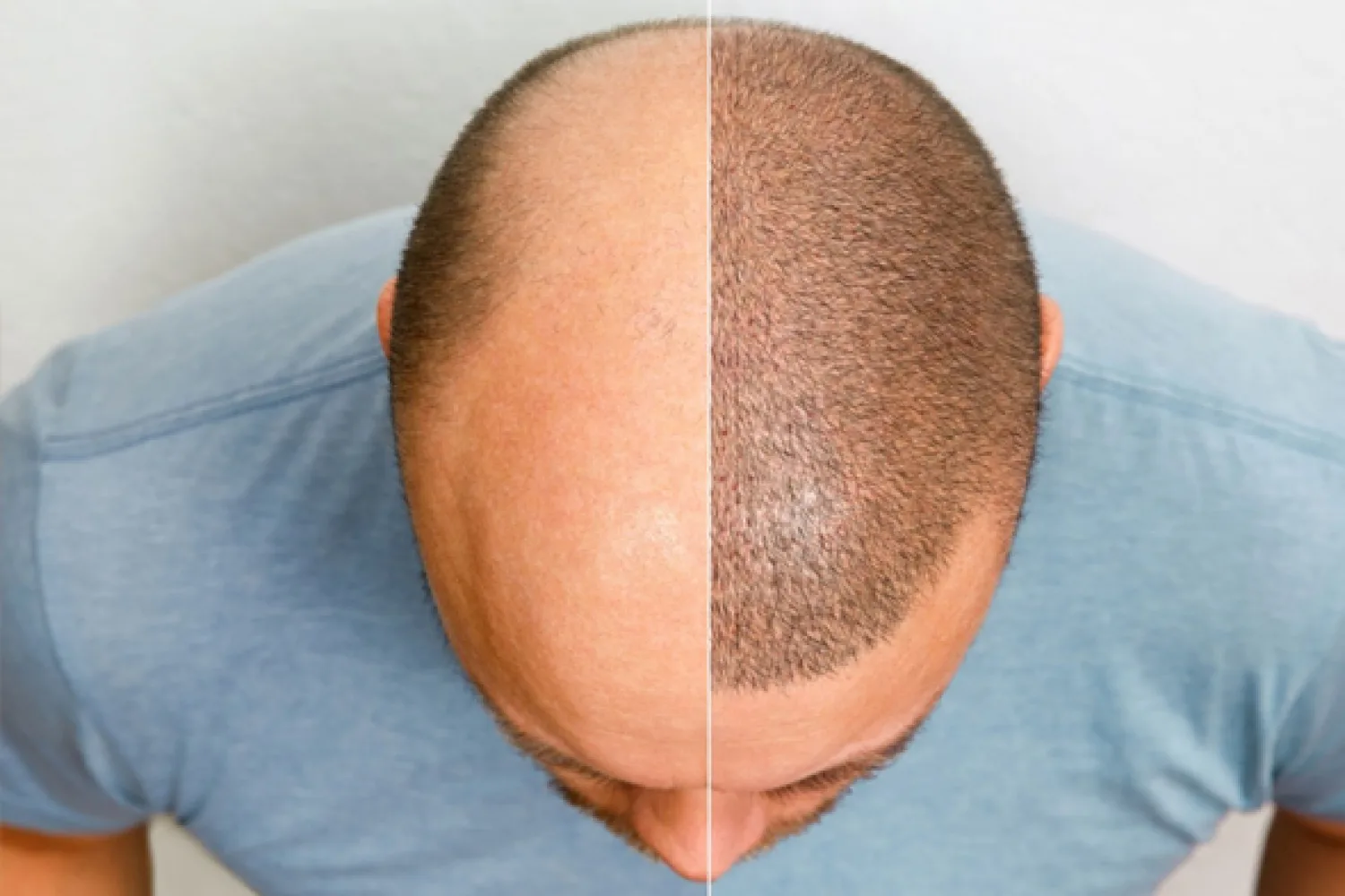 Haartransplantation Wuppertal: Individuelle Beratung und moderne Methoden