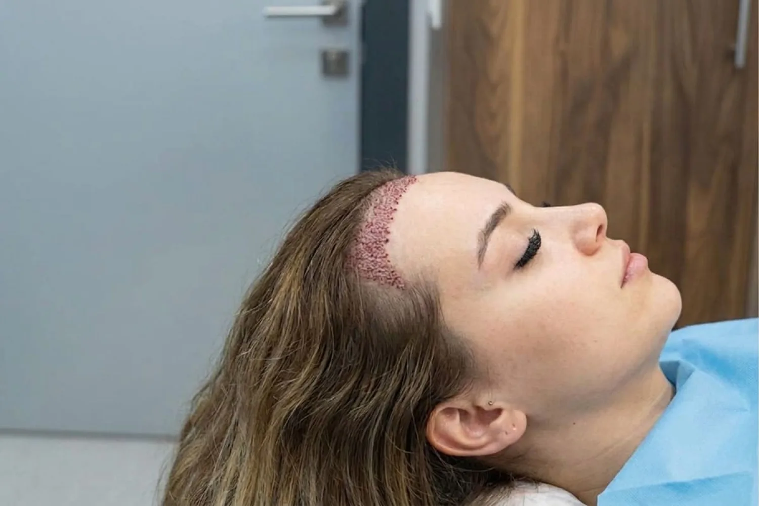 Spenderbereich Haartransplantation: Warum Haardichte, Haarstruktur und Heilung entscheidend sind