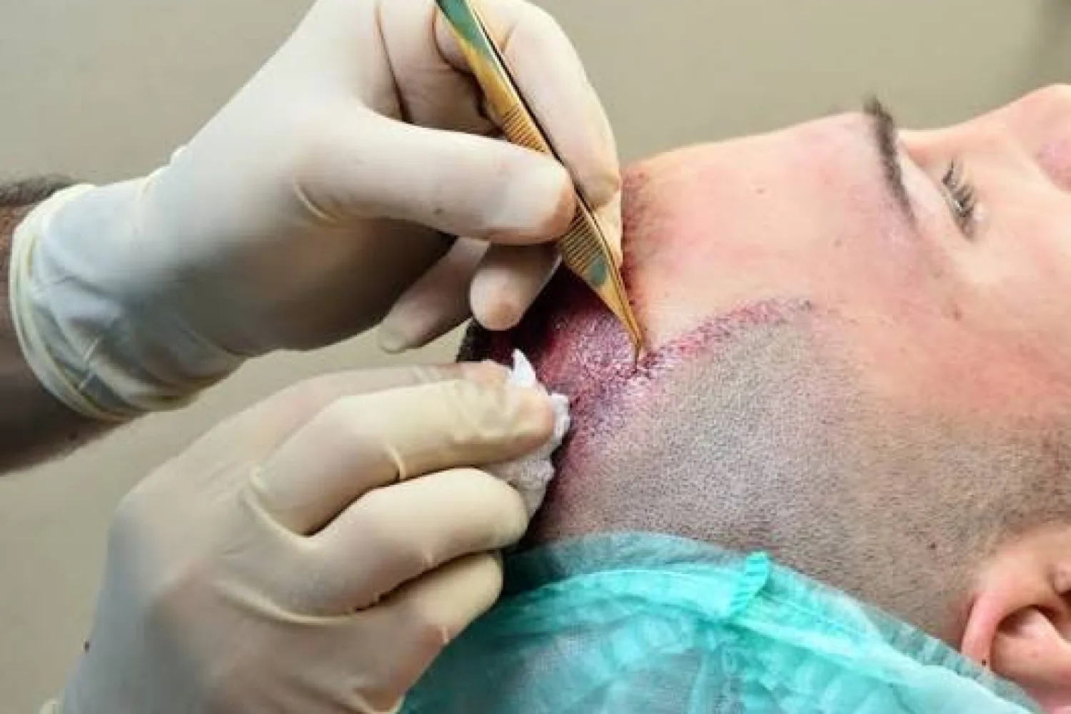 Haartransplantation Frauen: Moderne Lösungen bei Haarausfall und dünner werdendem Haar