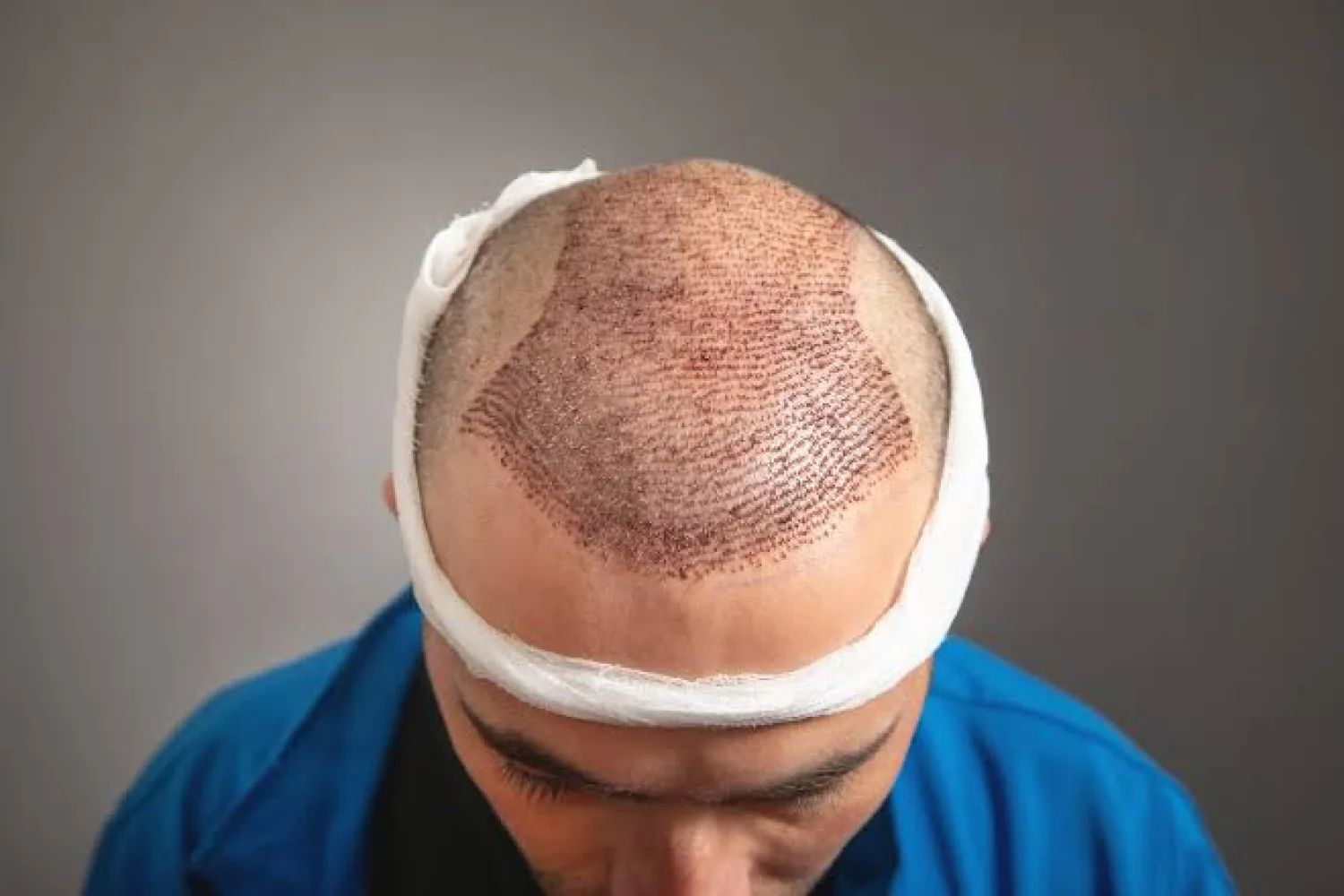 Barttransplantation: Mehr Bartdichte und natürliche Konturen für ein harmonisches Erscheinungsbild