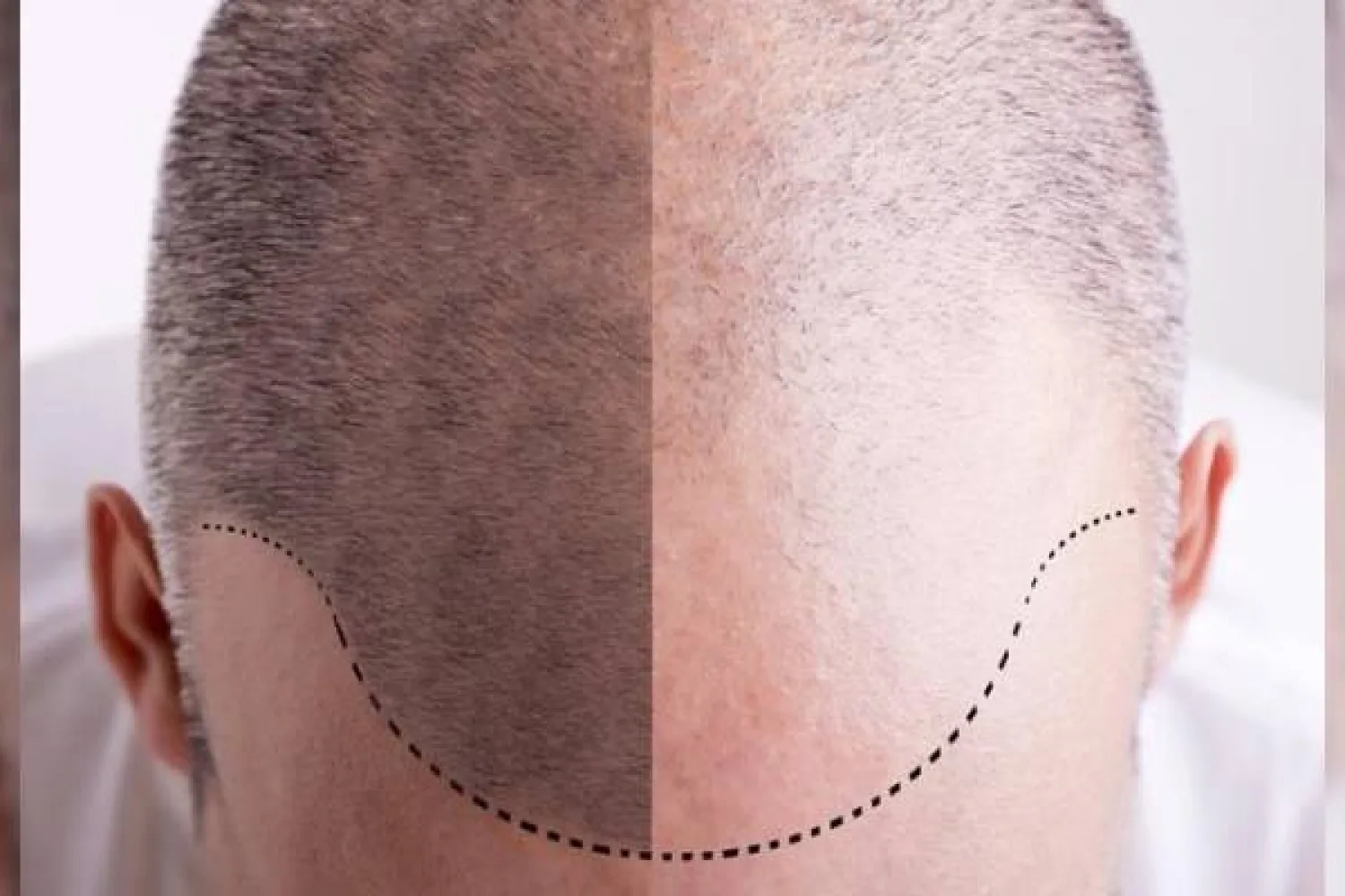Haartransplantation Geheimratsecken: Natürliche Haarlinie gezielt wiederherstellen