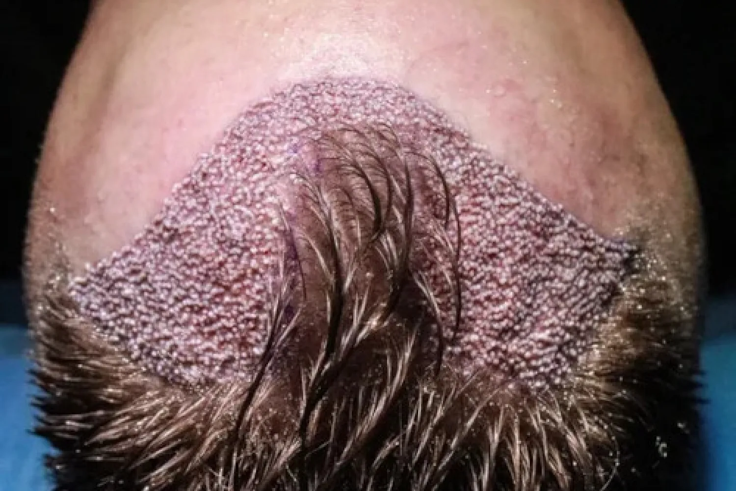 Haartransplantation Kosten Deutschland: Was beeinflusst den Preis?