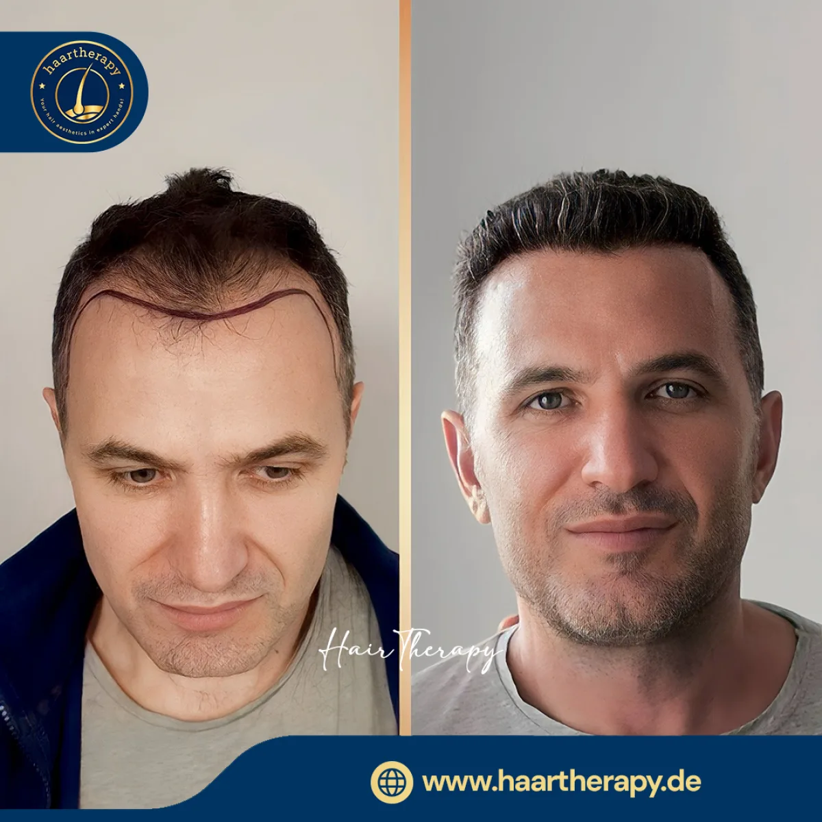 Behandlungsergebnis – Haartransplantation - FUE
