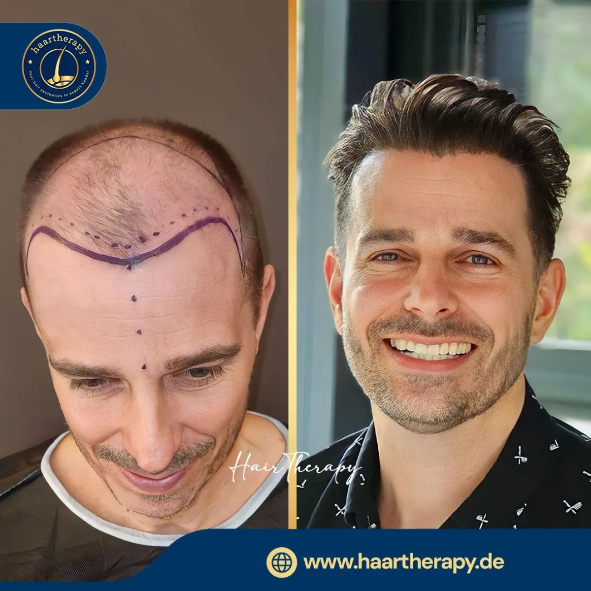 Behandlungsergebnis – Haartransplantation - FUE