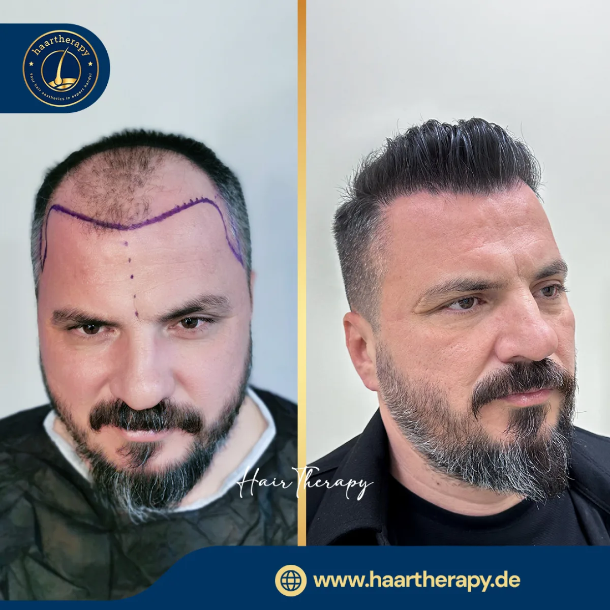 Behandlungsergebnis – Haartransplantation - FUE