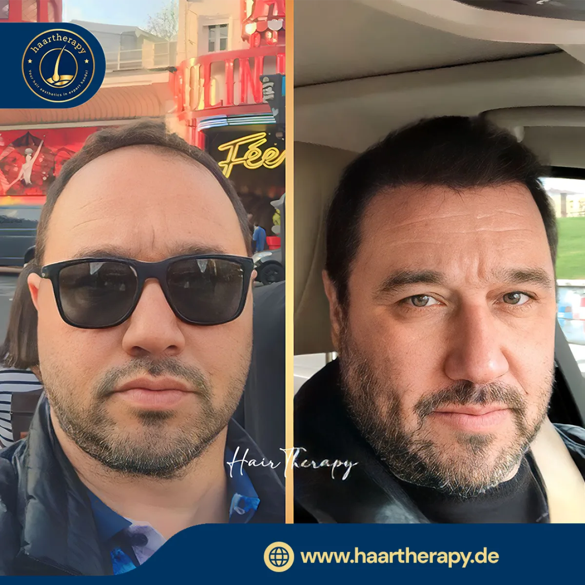 Behandlungsergebnis – Haartransplantation - FUE