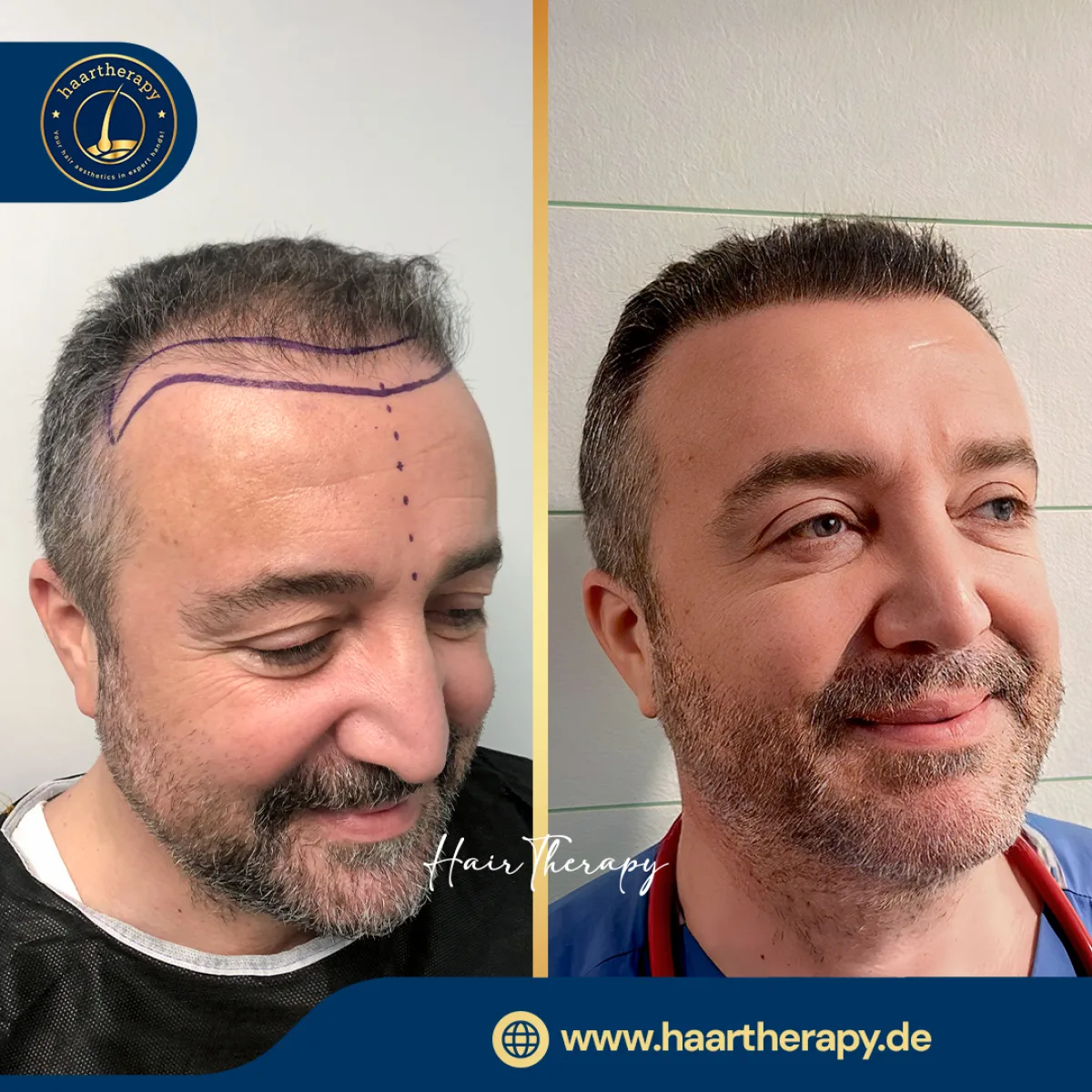 Behandlungsergebnis – Haartransplantation - FUE