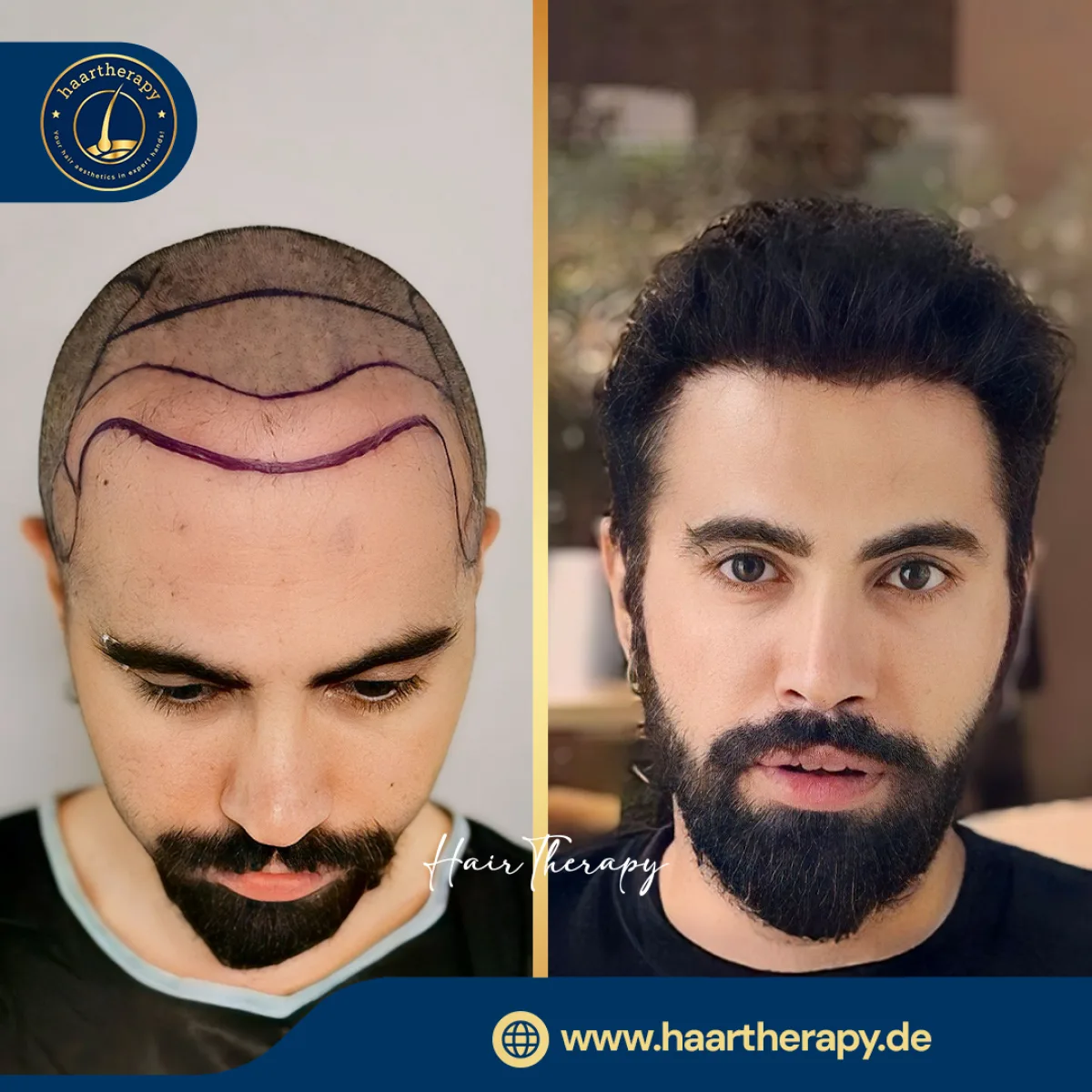 Behandlungsergebnis – Haartransplantation - FUE