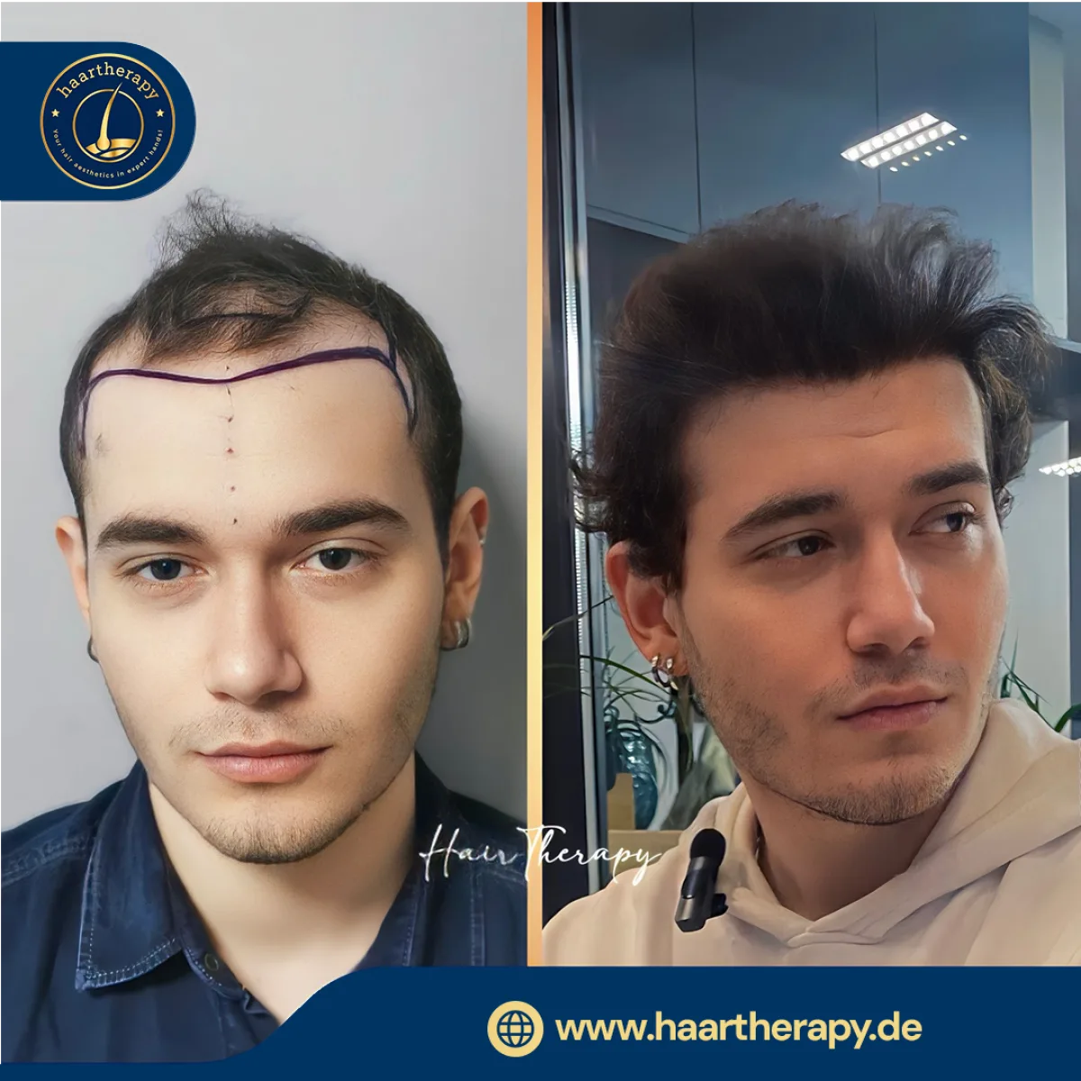 Behandlungsergebnis – Haartransplantation - FUE