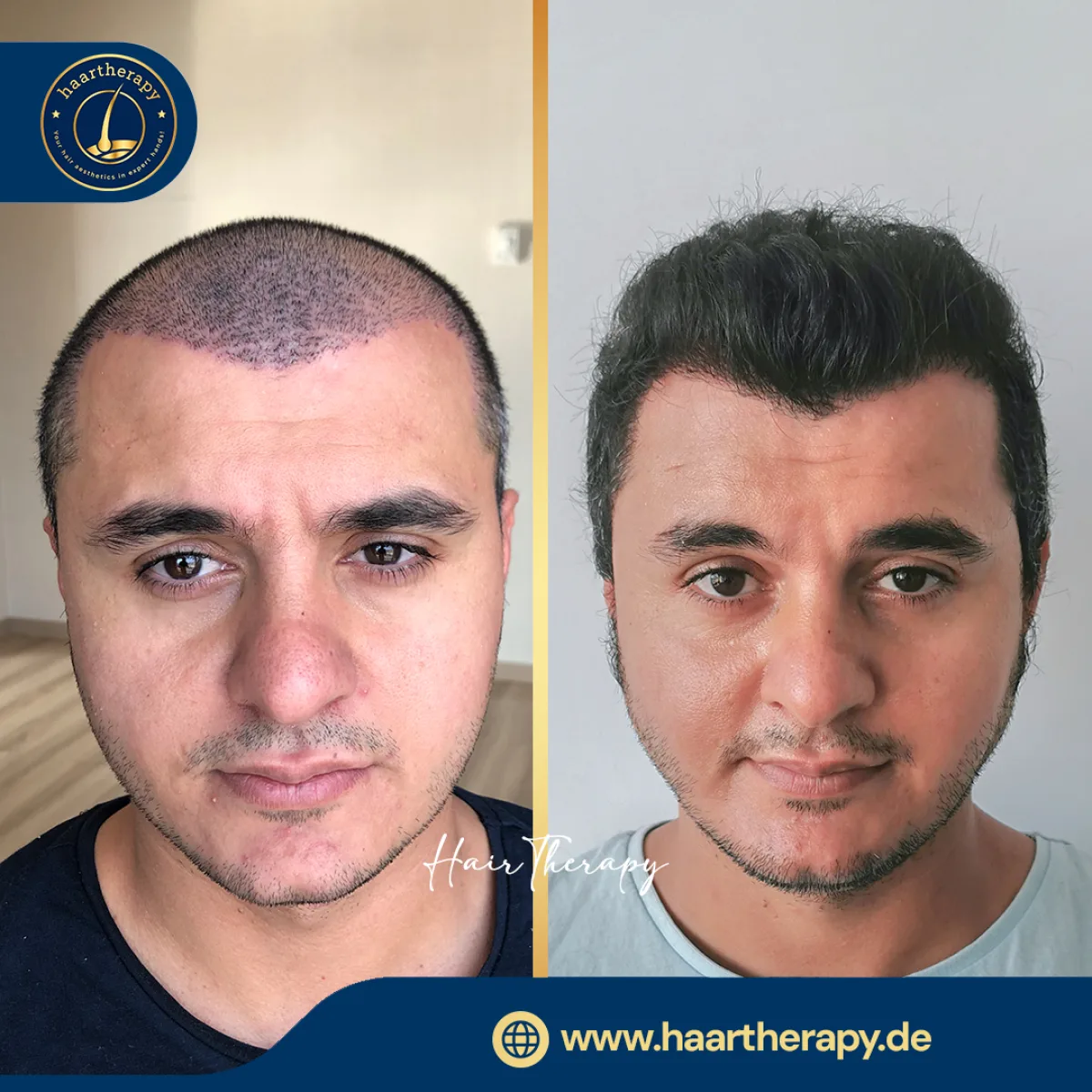 Behandlungsergebnis – Haartransplantation - FUE