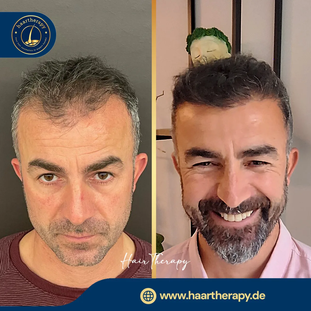Behandlungsergebnis – Haartransplantation - FUE