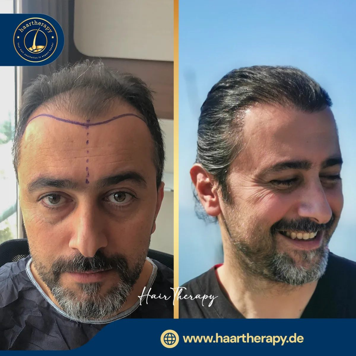 Behandlungsergebnis – Haartransplantation - FUE
