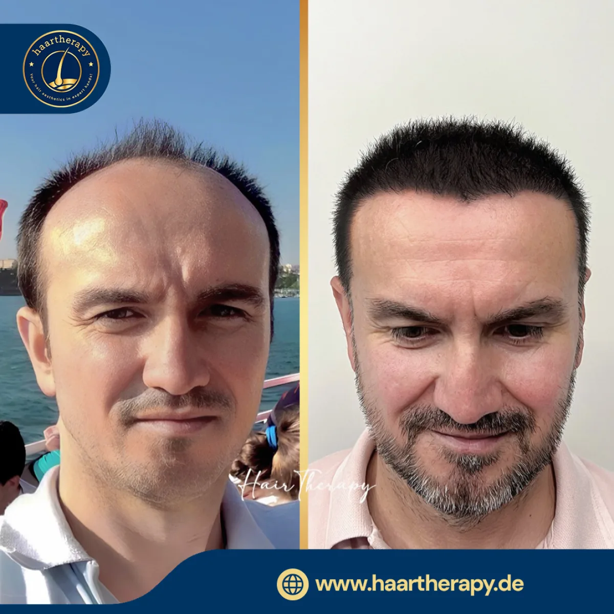 Behandlungsergebnis – Haartransplantation - FUE
