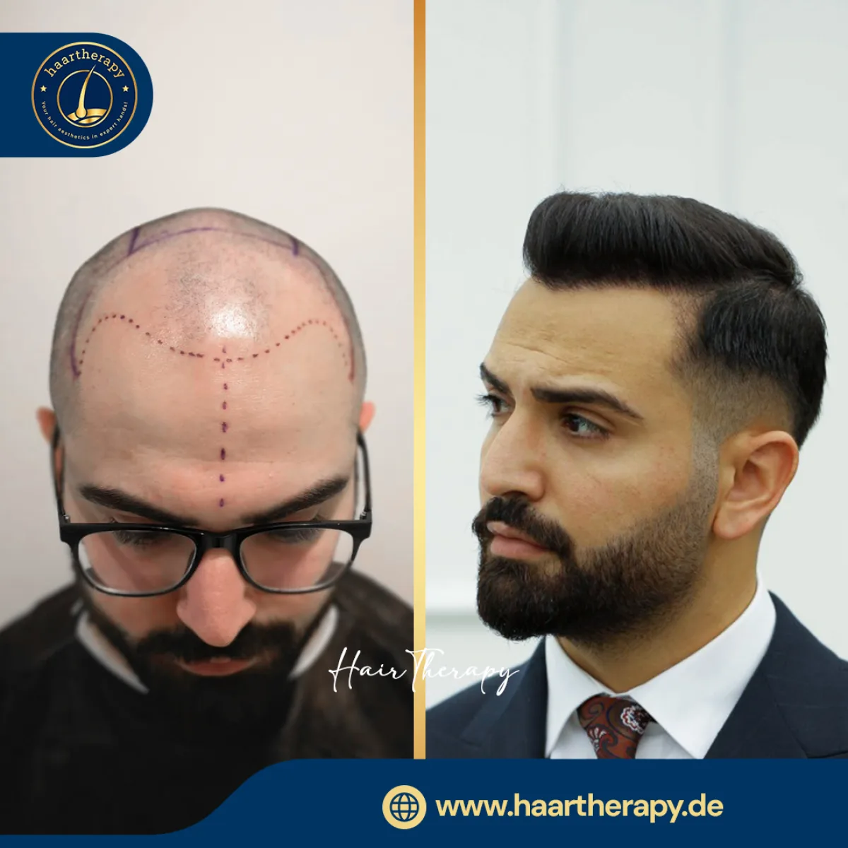 Behandlungsergebnis – Haartransplantation - FUE
