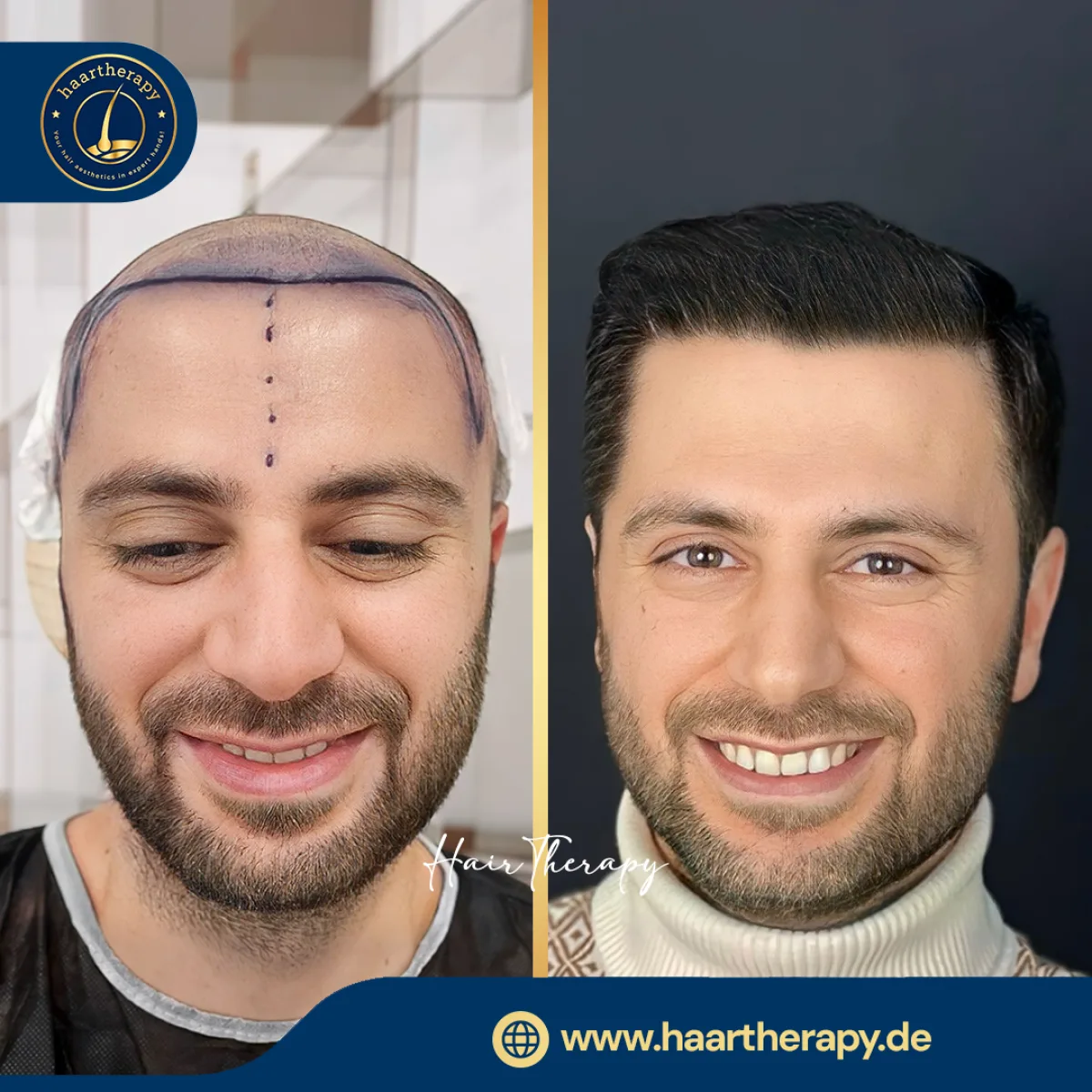 Behandlungsergebnis – Haartransplantation - FUE