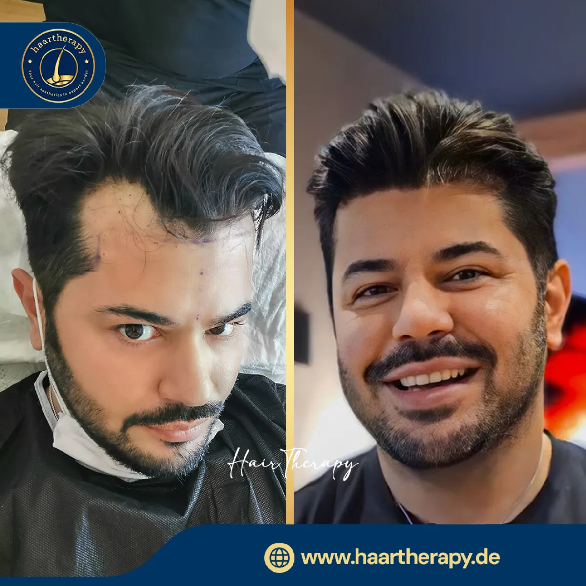 Behandlungsergebnis – Haartransplantation - FUE