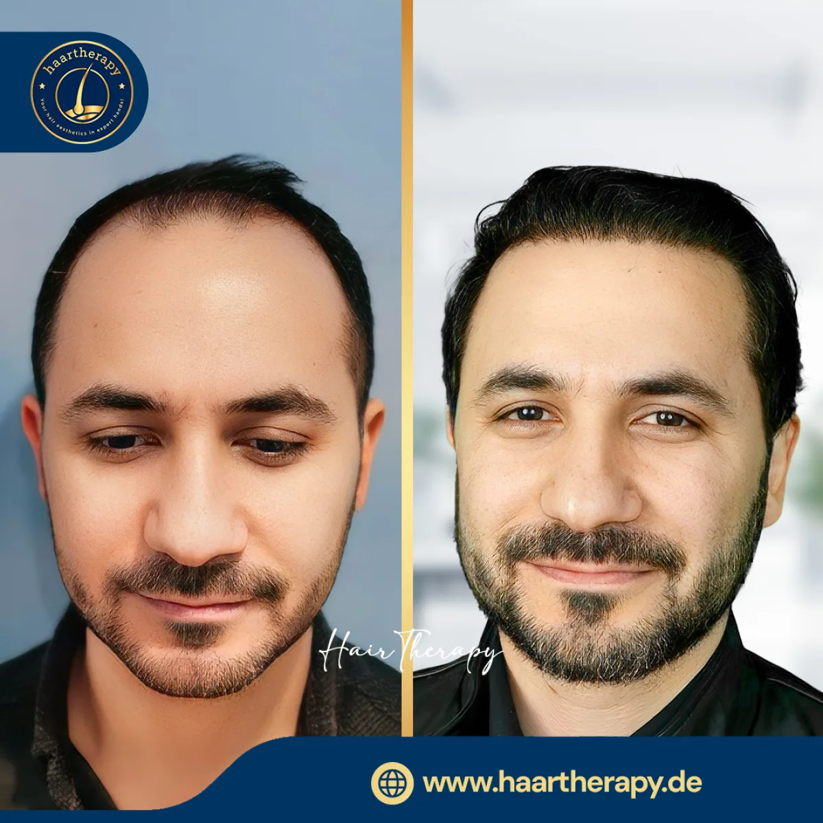 Behandlungsergebnis – Haartransplantation - FUE