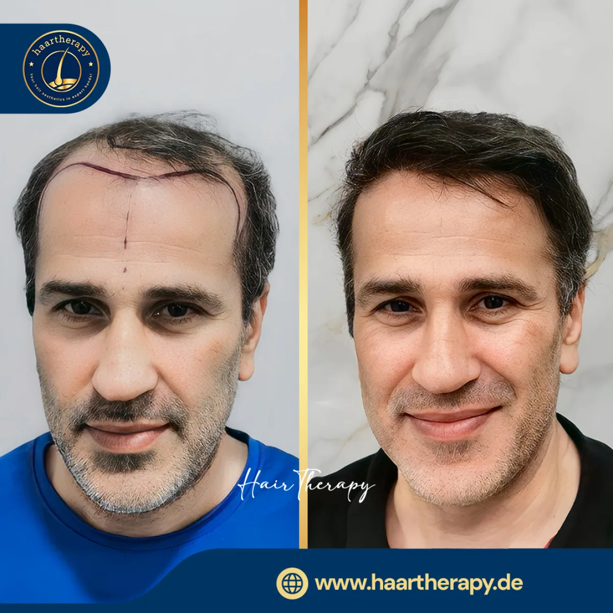 Behandlungsergebnis – Haartransplantation - FUE