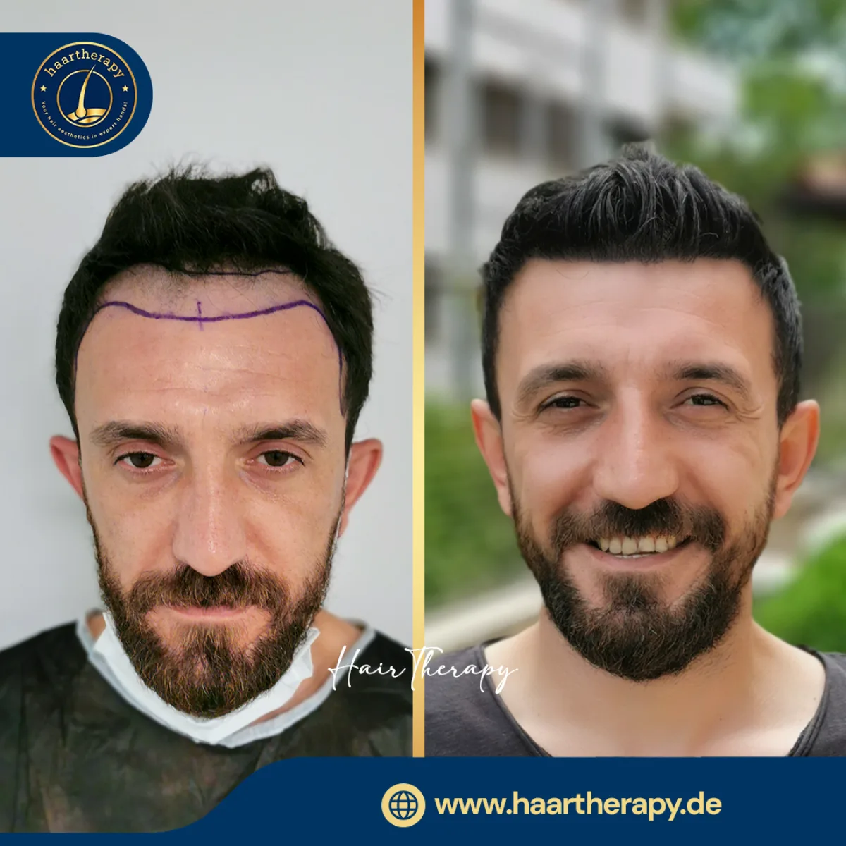 Behandlungsergebnis – Haartransplantation - FUE