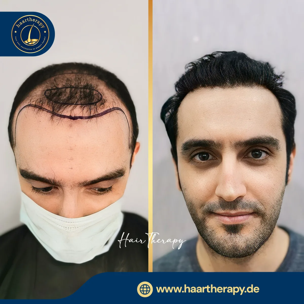 Behandlungsergebnis – Haartransplantation - FUE