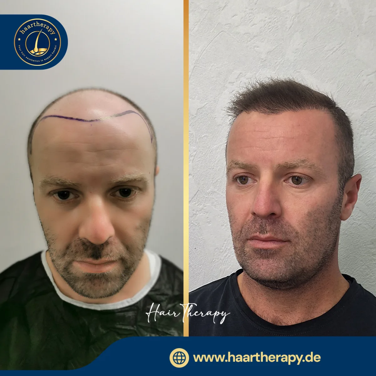 Behandlungsergebnis – Haartransplantation - FUE