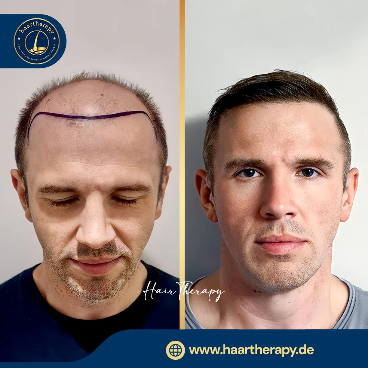 Behandlungsergebnis – Haartransplantation - FUE