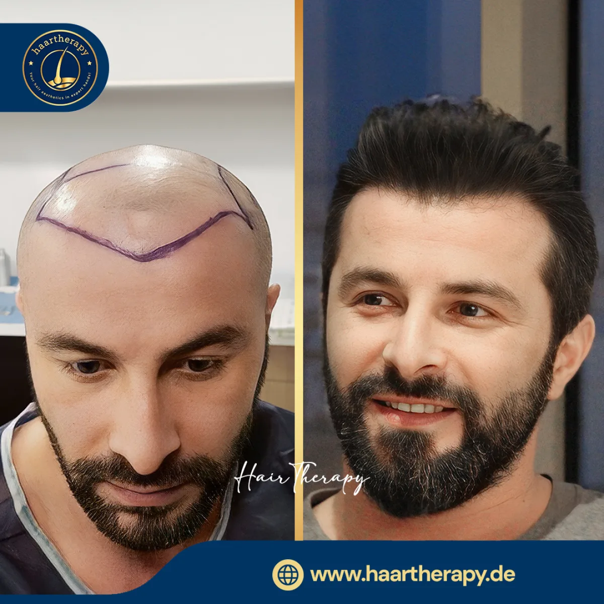 Behandlungsergebnis – Haartransplantation - FUE