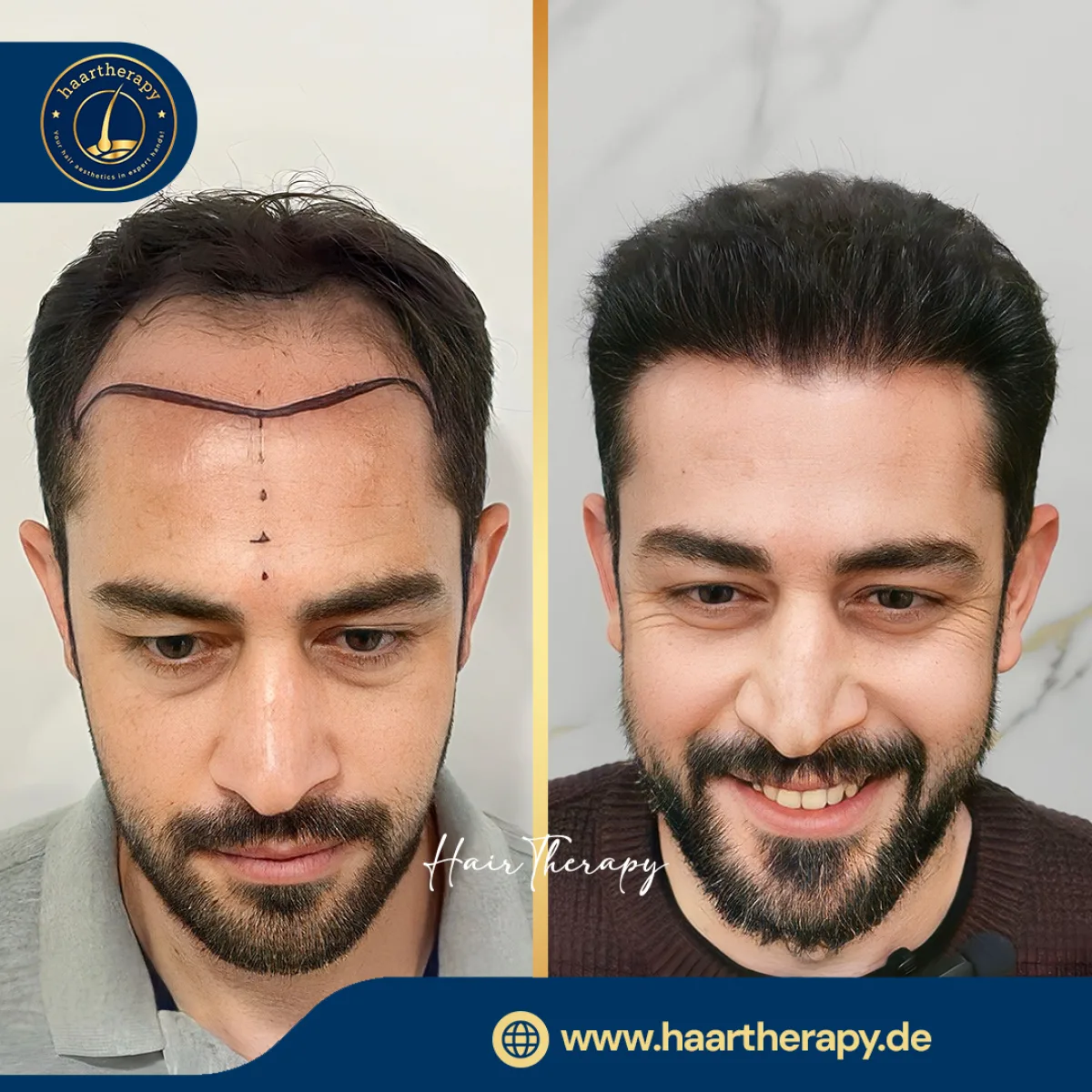Behandlungsergebnis – Haartransplantation - FUE
